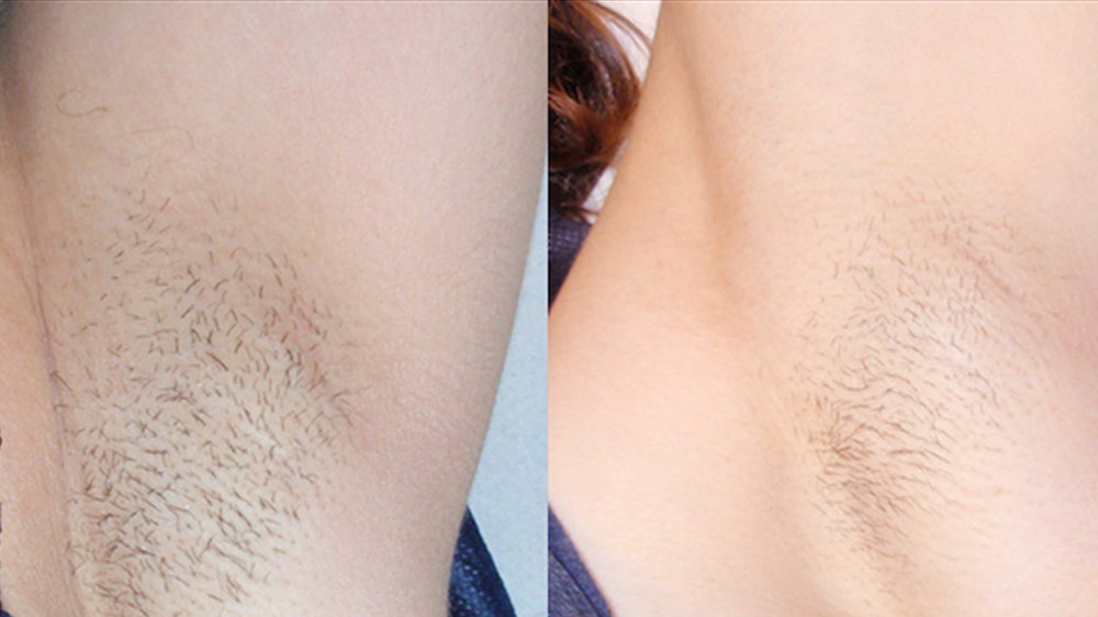 Underarm before and after laser hair reduction, shown side by side