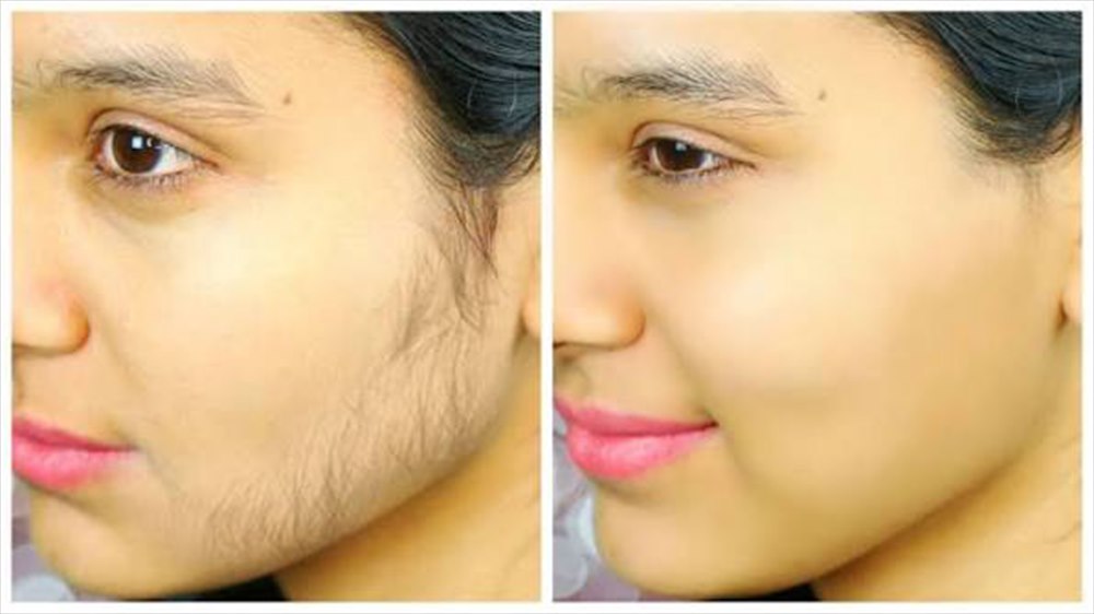 Cheek and jawline before and after hair removal, shown side by side