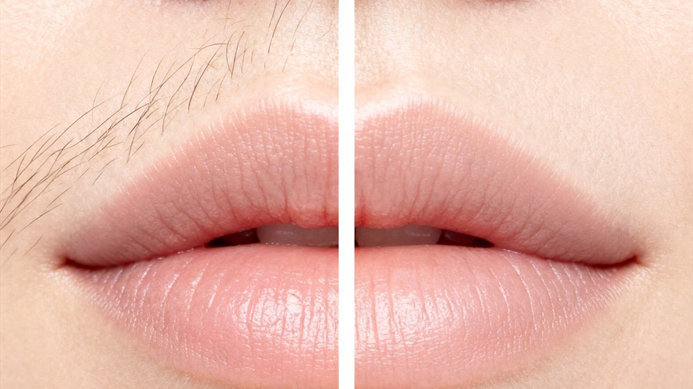 Upper lip before and after hair removal, shown side by side
